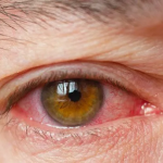 Long-Term Effects of Untreated Dry Eye Syndrome: Risks Every Patient Should Know