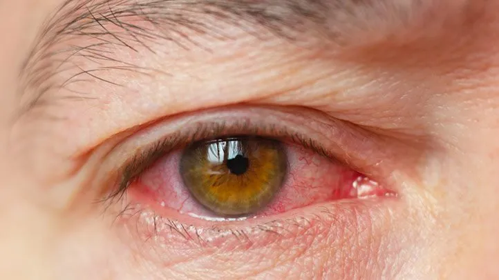 Long-Term Effects of Untreated Dry Eye Syndrome: Risks Every Patient Should Know